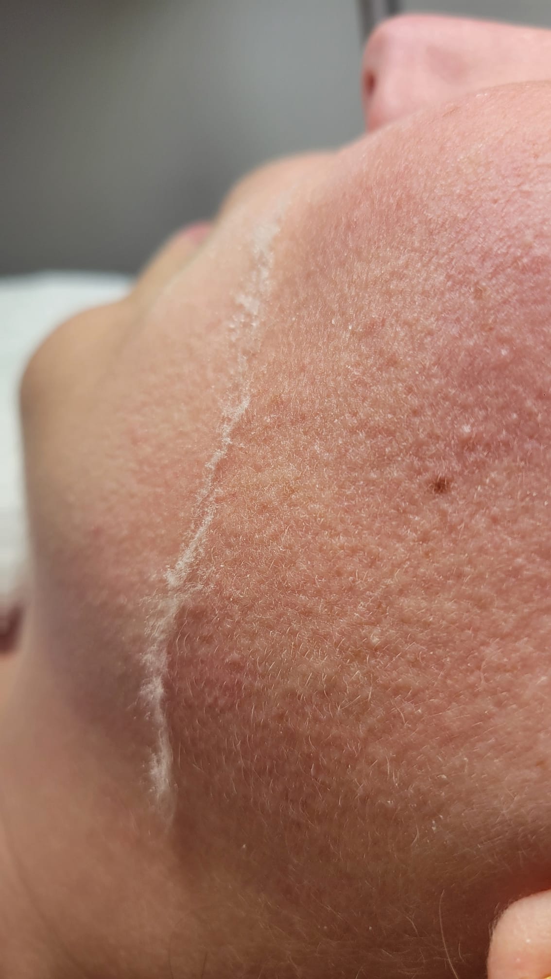 Dermaplaning behandeling bij Studio 13 Zonhoven